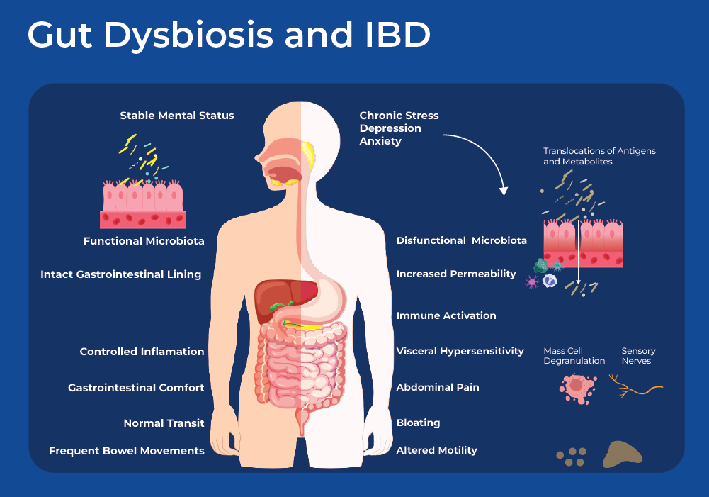 gut dysbiosis and Irritable Bowel Disease (IBD)