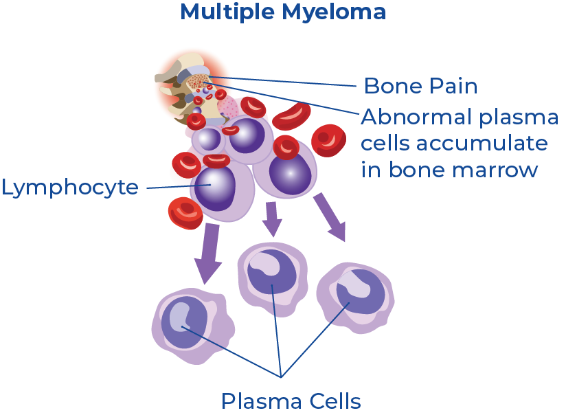 Multiple Myeloma diagram