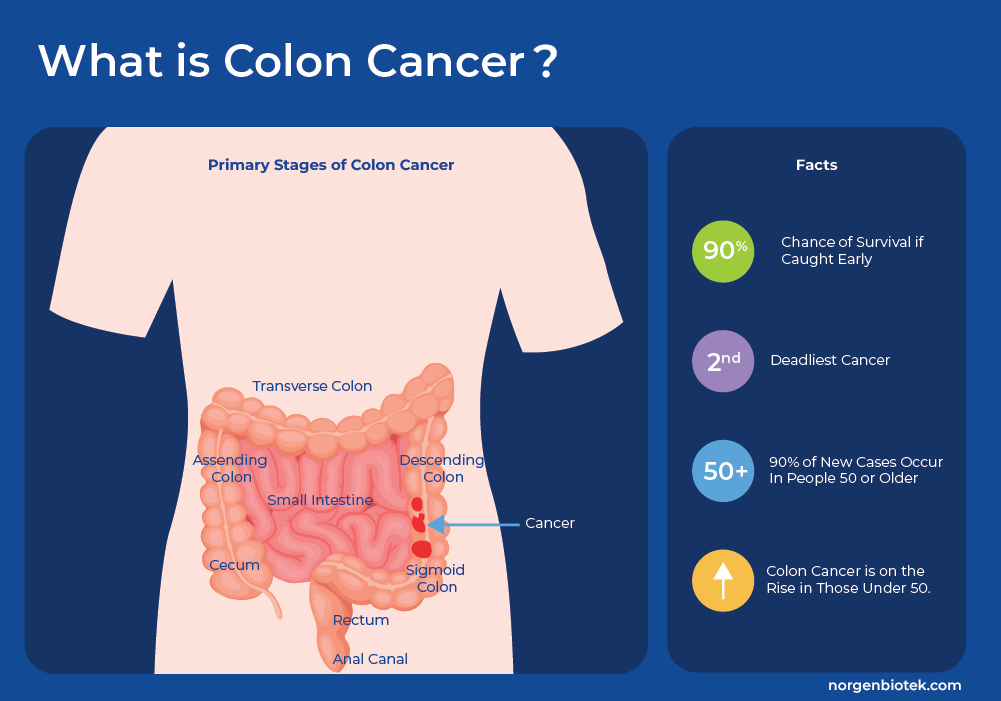 what is colon cancer
