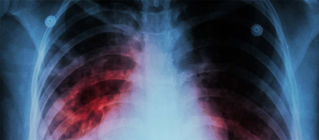 x-ray of human chest